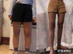 吸脂好还是打瘦腿针好 小腿抽脂好还是打瘦腿针好