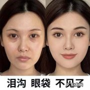有眼袋和泪沟怎么办 既有眼袋又有泪沟怎么办