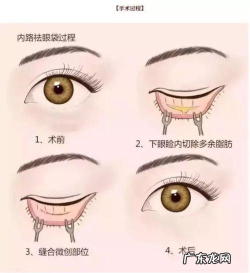 去眼袋最有效的方法有哪些 最有效的去眼袋方法有哪些