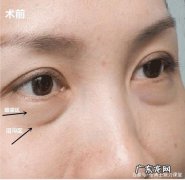 你要学会区分泪沟和眼袋他们不一样 泪沟和眼袋该怎么区分他们的不同