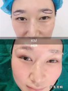 提眉后为什么变难看了