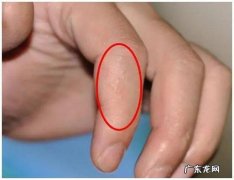 汗疱疹会扩散到整个手吗