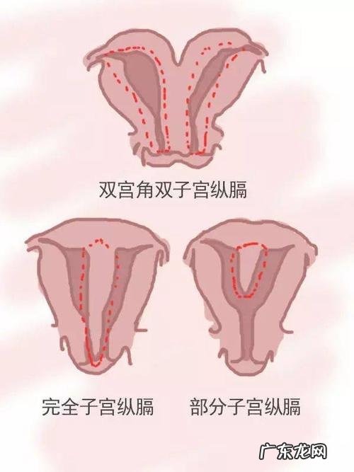 不全纵隔子宫是怎么回事 纵隔子宫是什么情况