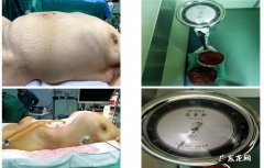 腹部吸脂多久能恢复好 抽脂肪肚子多久才能恢复正常