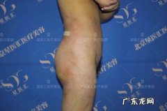 抽脂后的脂肪还会再长吗