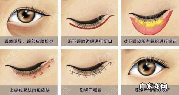 外切眼袋的过程是什么样子的