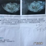 纵隔子宫怀孕有没有影响