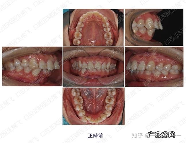 年近30隐形矫正牙齿还来得及吗