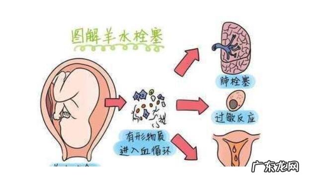 羊水栓塞能避免吗