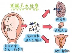 羊水栓塞一年大概有几例