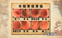 胃癌复发的六大征兆是哪些
