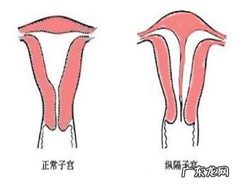 完全纵隔子宫能生孩子吗