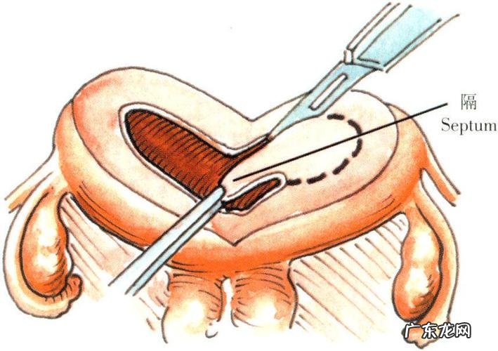 纵隔子宫做了手术影响生育吗