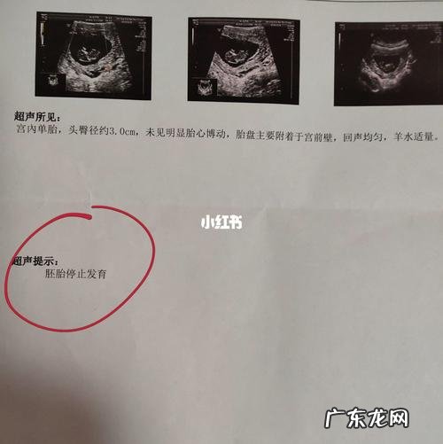 胎停有什么症状 为什么胎停了医生还让孕妇观察一周