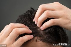 头屑多怎么回事，怎么办、