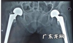 尾巴骨摔伤怎么办很疼 尾巴骨摔伤怎么办