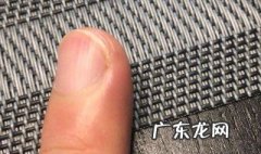 指甲有竖线是什么病 指甲有竖线是什么