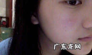 脸上长痘后留下黑色印怎么办 脸上长痘痘后留下黑色素是什么原因是什么
