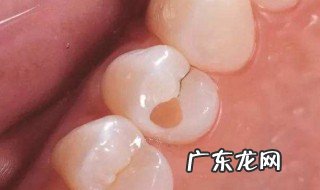 拔完牙后第一天可以吃什么 拔完牙齿第一天可以吃什么