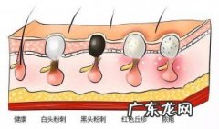 如何判断毛孔是否粗大? 怎么判断毛孔粗大