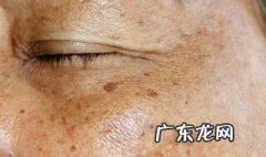 什么是雀斑和黄褐斑的区别 什么是雀斑和黄褐斑