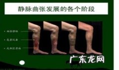 啥是静脉曲张 啥静脉曲张是在腹股沟处开刀