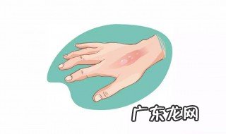 开水烫伤如何处理 开水烫伤应该怎么办