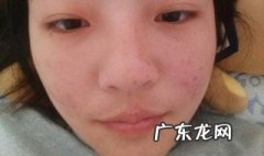 如何祛痘印 如何祛痘印学生
