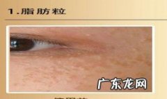 如何去除眼部脂肪粒小妙招图片 如何去除眼部脂肪粒