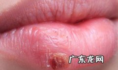 嘴巴上火起泡吃什么 嘴巴上火起泡吃什么降火最快