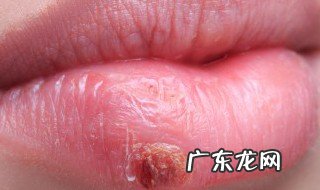 嘴巴上火起泡吃什么 嘴巴上火起泡吃什么降火最快