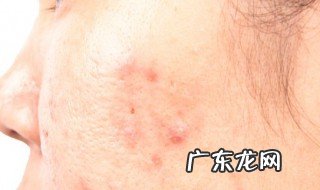 怎样快速祛痘学生 怎样快速祛痘