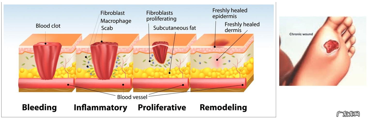伤口怎么快速愈合