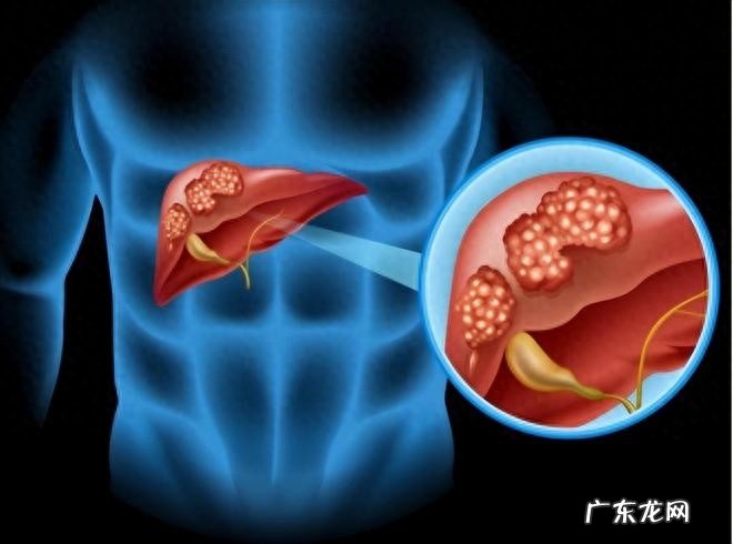 体内有癌，肩膀先知？提醒：肩膀若出现这种异常，或是癌症信号