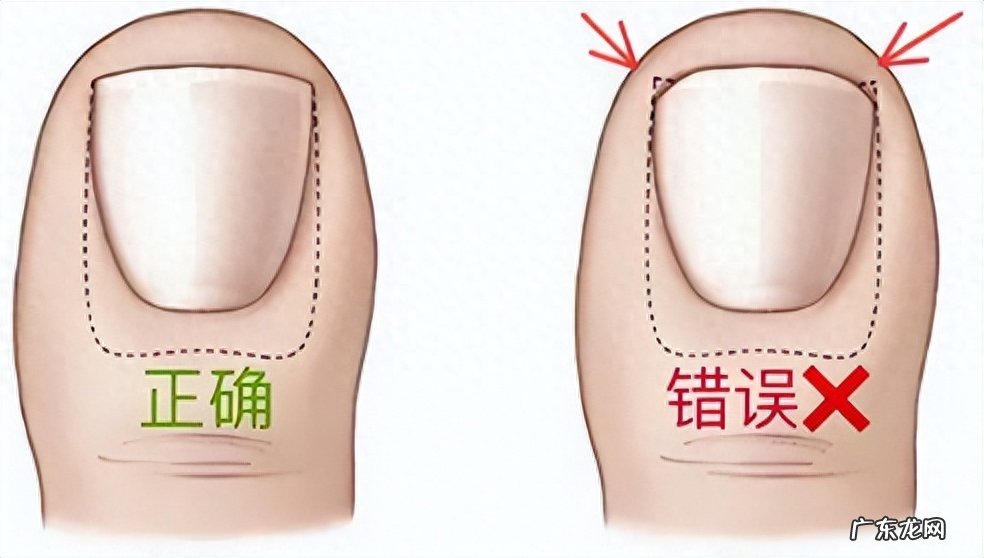 脚趾甲老往肉里钻,一碰还疼?教你小妙招,预防甲沟炎告别疼痛