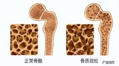 每天喝牛奶、吃钙片，却还是得了骨质疏松？医生告诉你真相