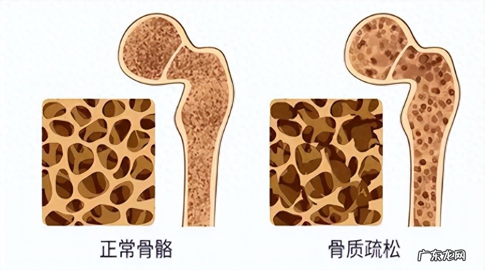 每天喝牛奶、吃钙片,却还是得了骨质疏松?医生告诉你真相
