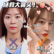 怎么样让鼻子看起来更好看