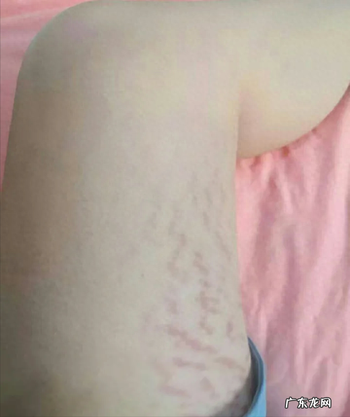 和女友同居第一天,去洗澡发现她屁股大腿都有白纹,这是咋回事?