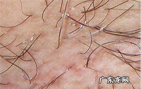 腋窝下有腋毛怎么办,腋下毛发旺盛怎么办