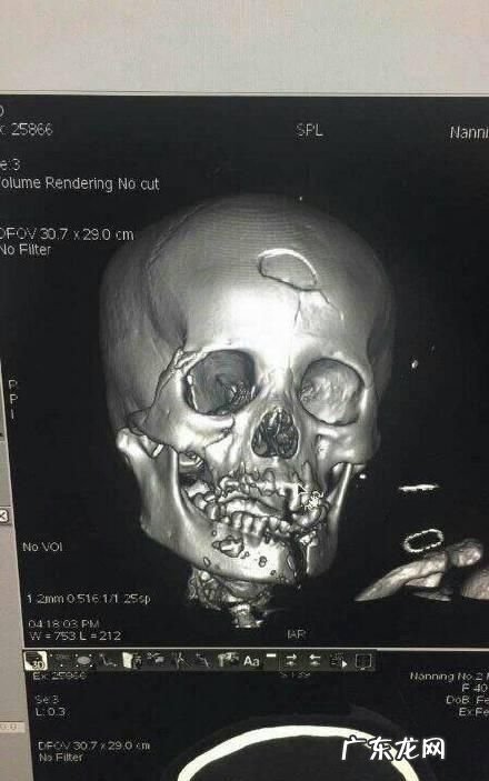 两人打架颅骨骨折算轻伤吗？,颅骨骨折会构成轻伤