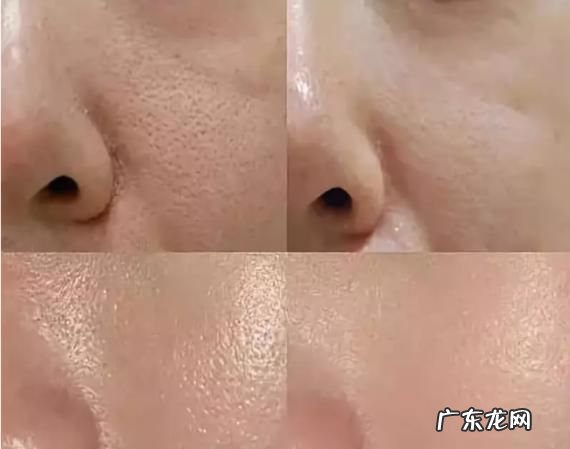 怎么改善毛孔变大,改善面部毛孔粗大的妙招