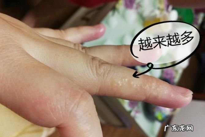 天气一热手上就长水泡怎么办,一到夏天手指上就长小水泡是怎么回事