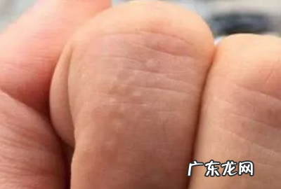 天气一热手上就长水泡怎么办,一到夏天手指上就长小水泡是怎么回事