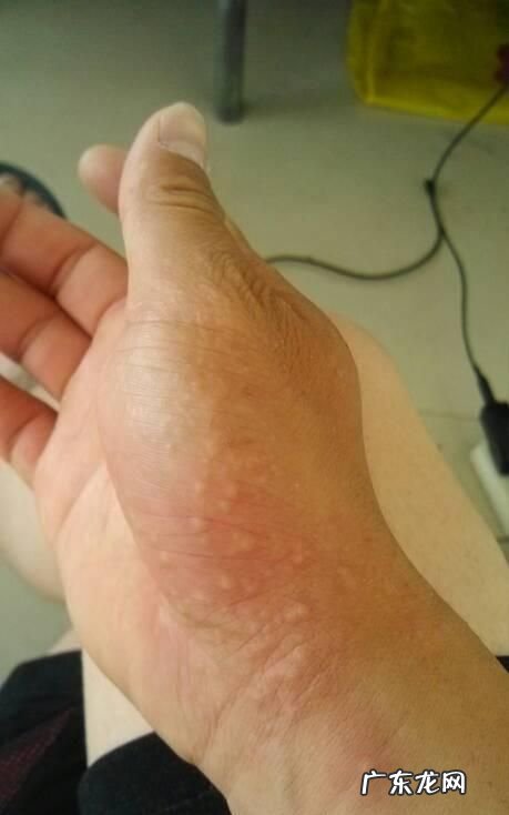 天气一热手上就长水泡怎么办,一到夏天手指上就长小水泡是怎么回事