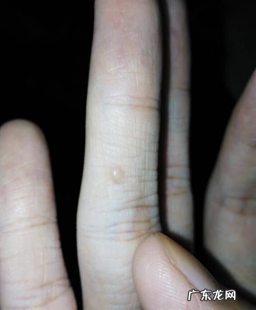天气一热手上就长水泡怎么办,一到夏天手指上就长小水泡是怎么回事