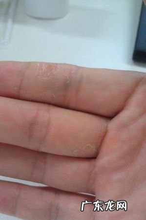 手很痒怎么办 手很痒是怎么回事,手痒是怎么回事儿