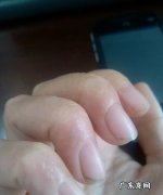 手很痒怎么办 手很痒是怎么回事,手痒是怎么回事儿