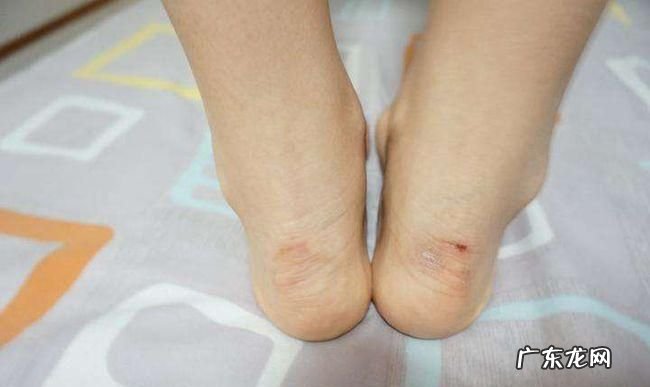 鞋子磨脚后跟怎么办,鞋子磨脚后跟怎么处理就不磨脚了