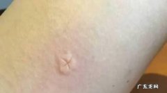 为什么蚊子咬了会痒,腿上没有被蚊子咬为什么会痒